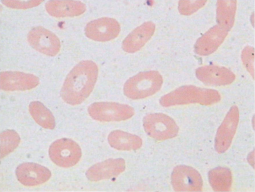 椭圆形红细胞